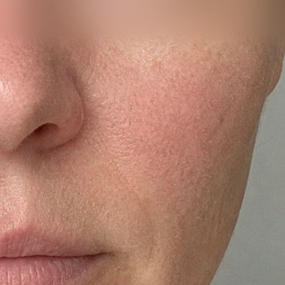 Profunda The Treatment Mask — Week 0